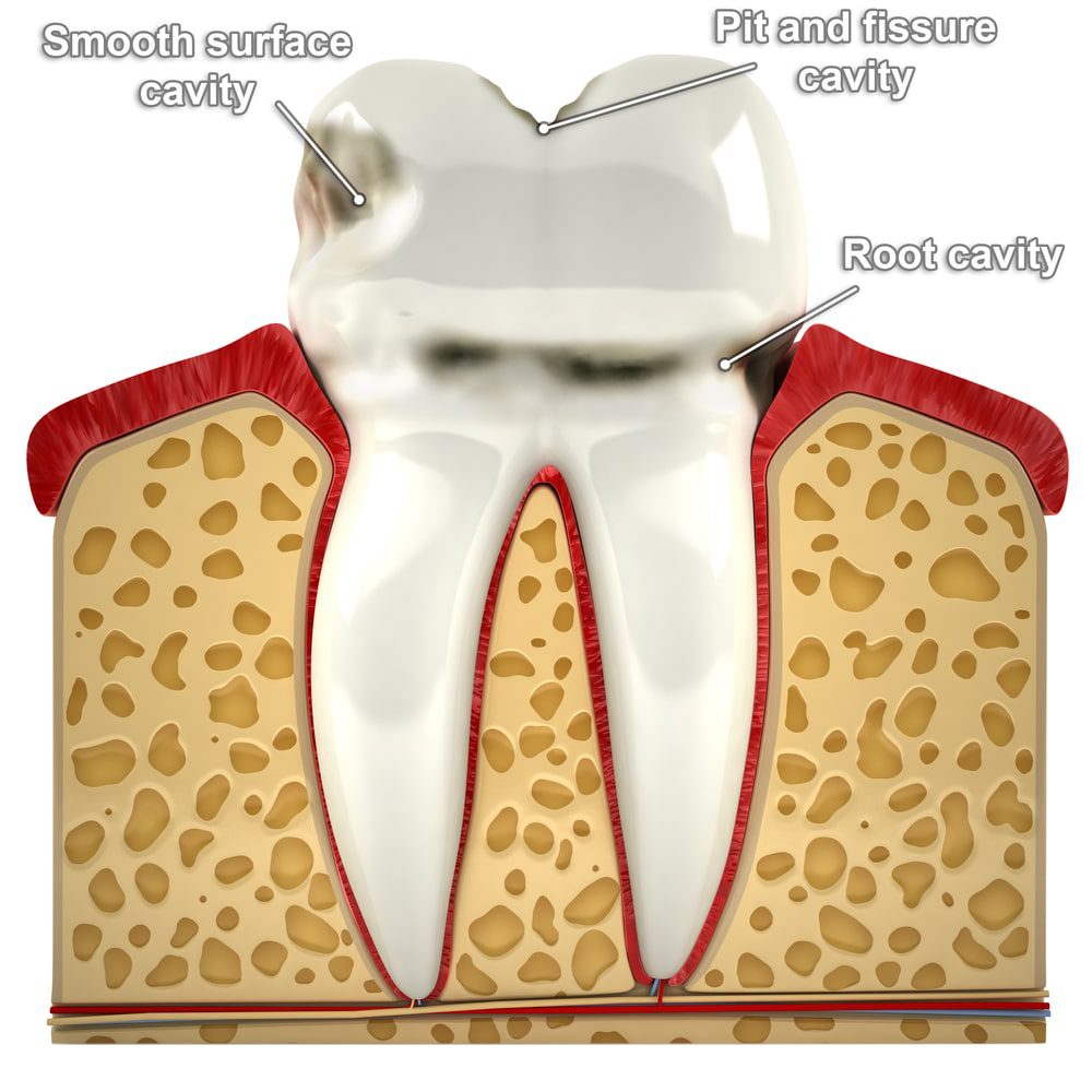 type of cavities