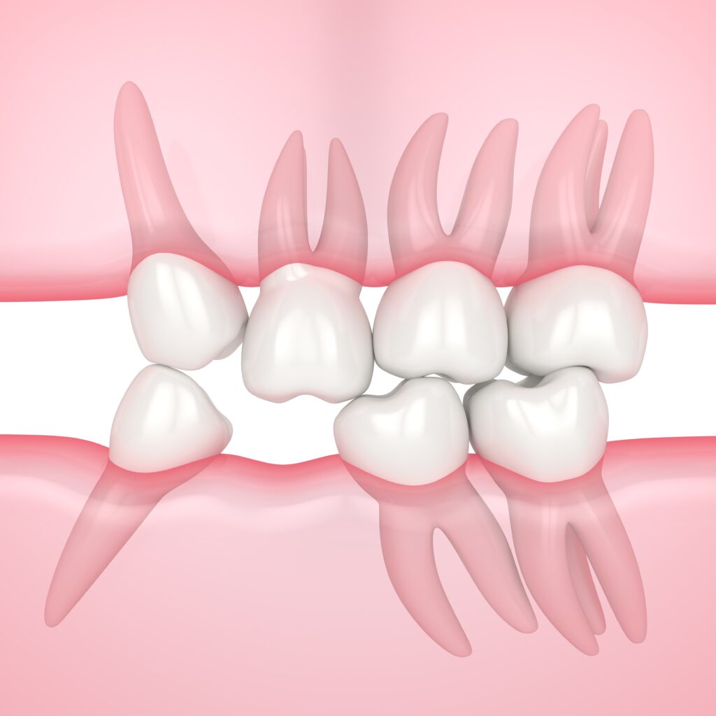 missing tooth causing alignment problems