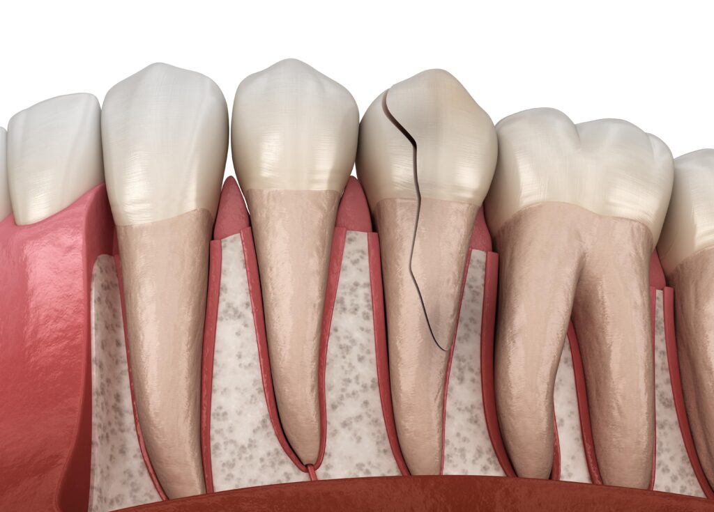 fractured tooth and root