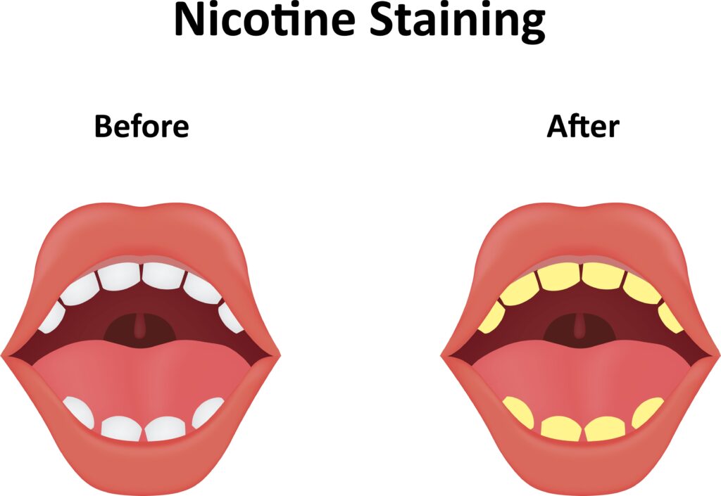 before and after nicotine stains on teeth