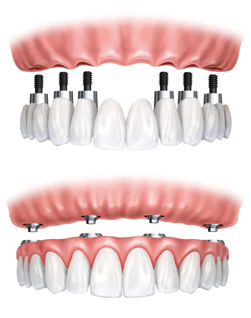 Traditional Implants (Top) vs. All-on-Four Implants (Bottom)