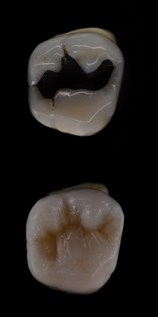 composite fillings