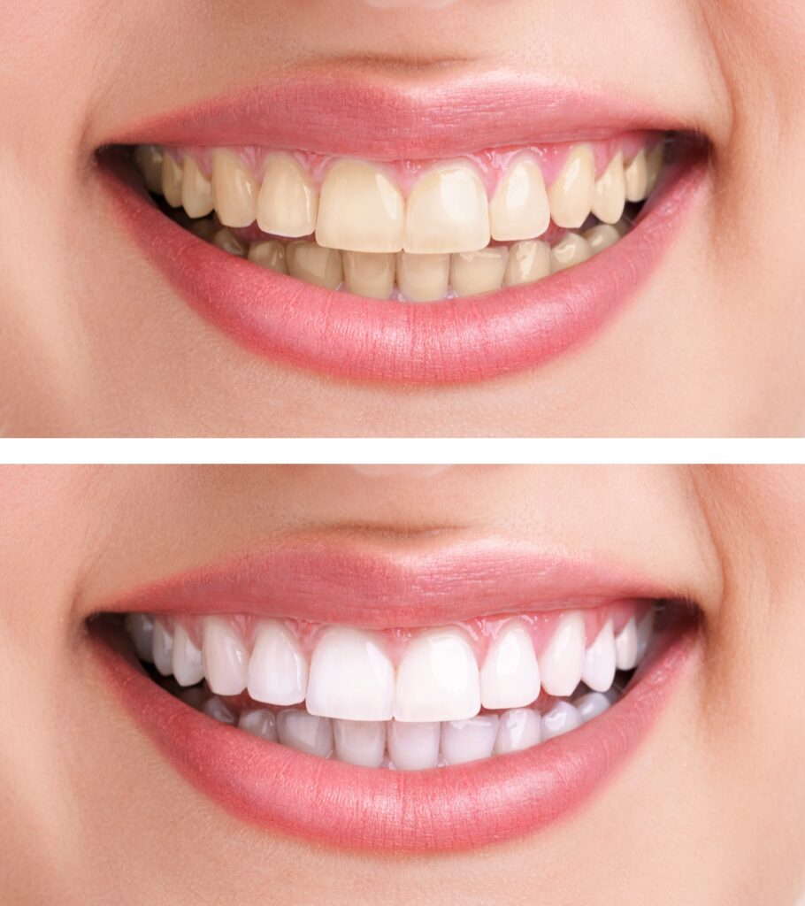 teeth whitening before and after