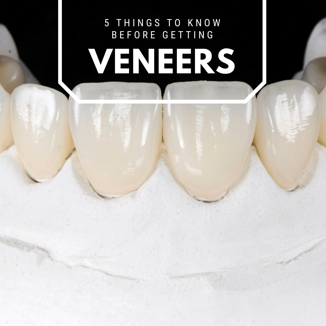 5 Things to Know Before Getting Veneers Empire Dental