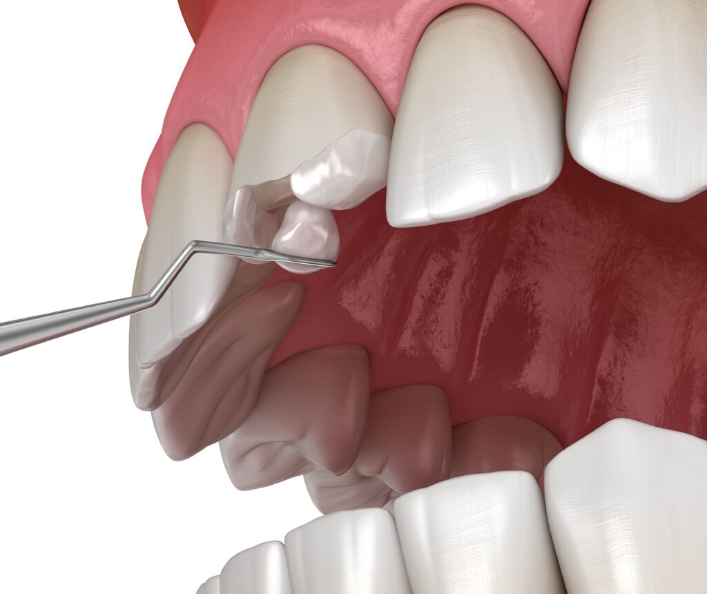 fixing a chipped tooth with dental bonding