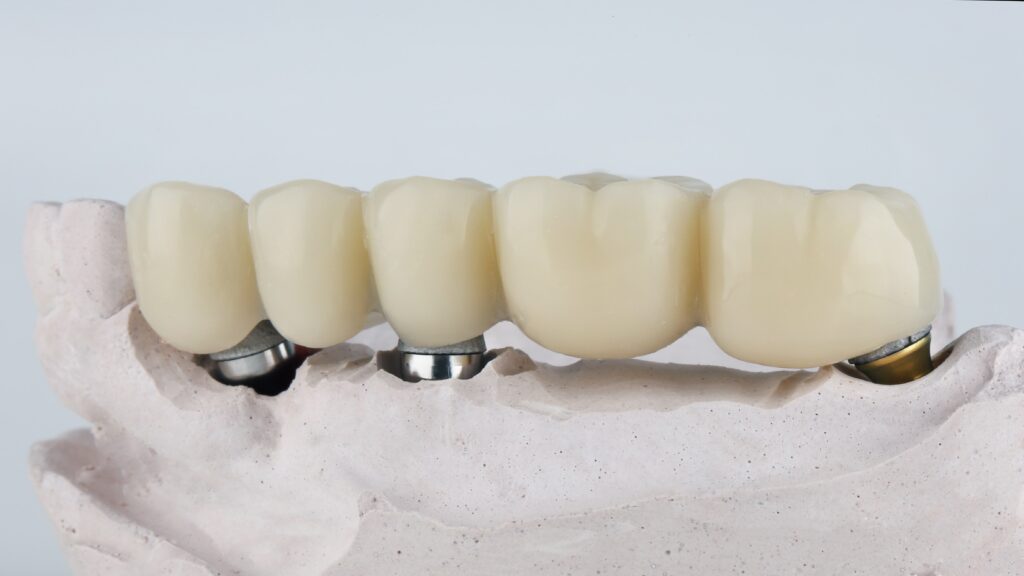 long bridge with three dental implants