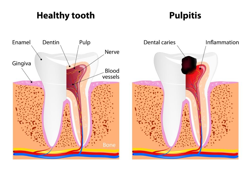 healthy tooth vs tooth with pulpitis