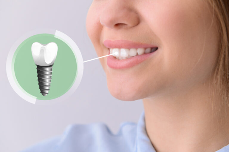 Facts About Dental Implants