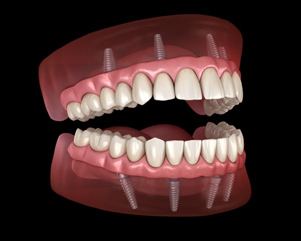 whats-included-in-all-on-4-treatment